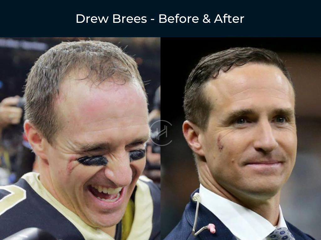 Before-and-after photos of Drew Brees's hair transformation Before-and-after photos of Drew Brees's hair transformation