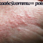 How to Treat skin:aa6c5vornmw= poison oak: Expert Tips and Advice