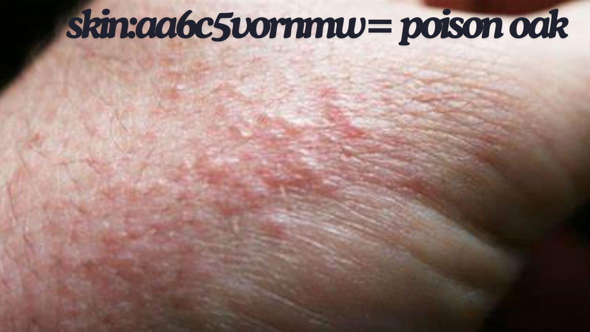 How to Treat skin:aa6c5vornmw= poison oak: Expert Tips and Advice